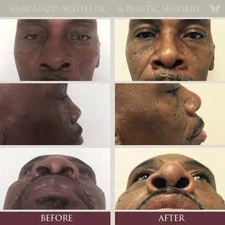 black-nose-before-and-after_800px-574x574