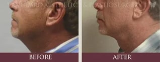 florida_chin_implant_neck_lift_1_before_and_after_side_800px-574x225