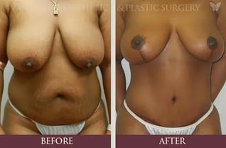 florida_mommy-makeover_before_and_after_574x377