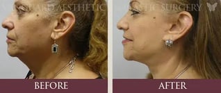 florida_neck-lift_1_before_and_after_800px-574x243