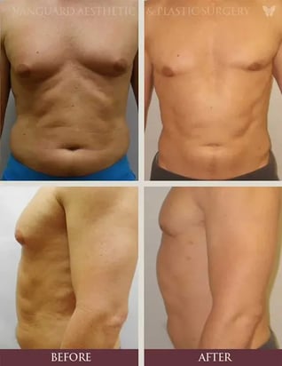 florida_plastic_surgeon_gynecomastia_before_after_574x745