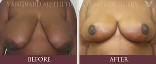 florida_plastic_surgery_breast_reduction_before_after_800px-574x237