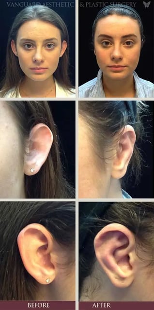 florida_plastic_surgery_ear_otoplasty_before_after_800px_2-574x1150