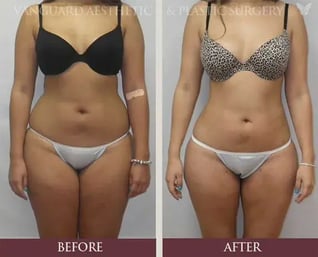 florida_plastic_surgery_liposuction_before_after_574x464