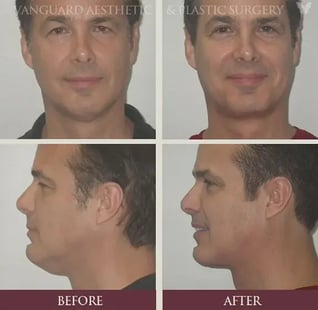 florida_plastic_surgery_male_neck_lift_before_after_800px-574x561