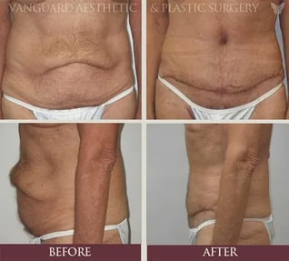florida_plastic_surgery_male_tummy_tuck_before_and_after_800px_574x519