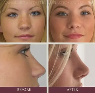 florida_plastic_surgery_rhinoplasty_nose_job_frontside_blonde-574x560