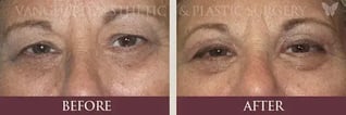 new_florida_blepharoplasty-before-and-after_800px-574x192