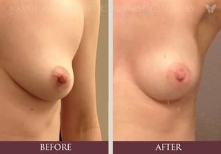 nipple-reduction-before-and-after_front_rev_800px-574x402