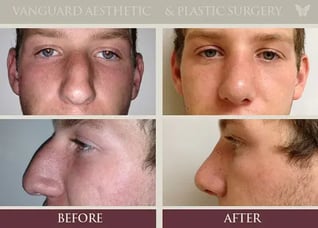 white-nose-before-and-after_rev_800px-574x413