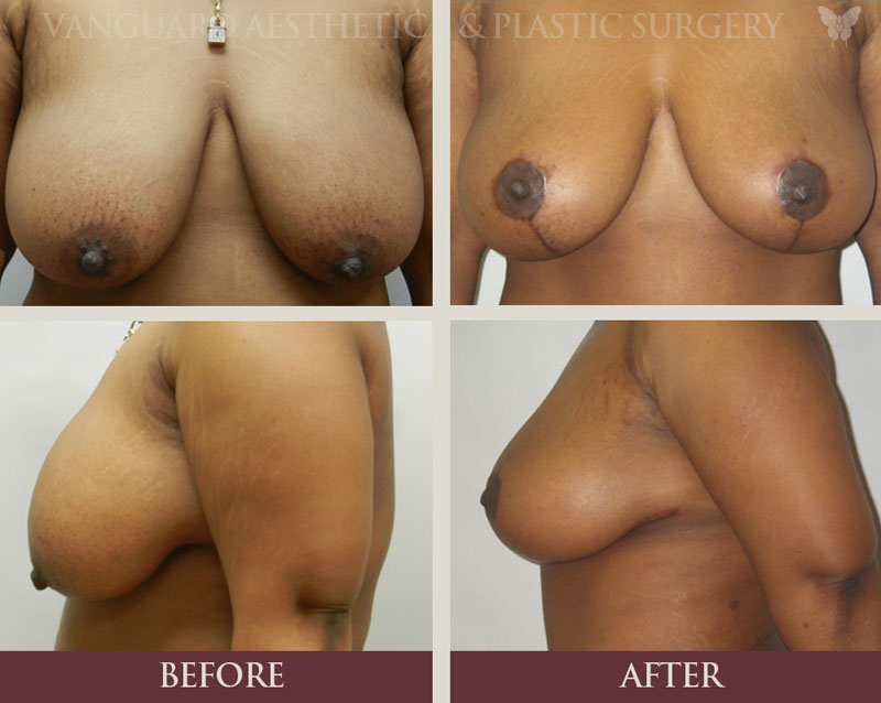 florida plastic surgery breast lift before and after mommy makeover