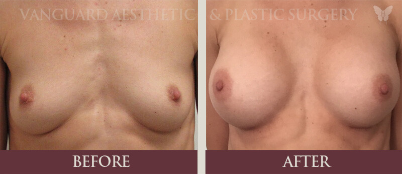 florida plastic surgery breast augmentation before and after