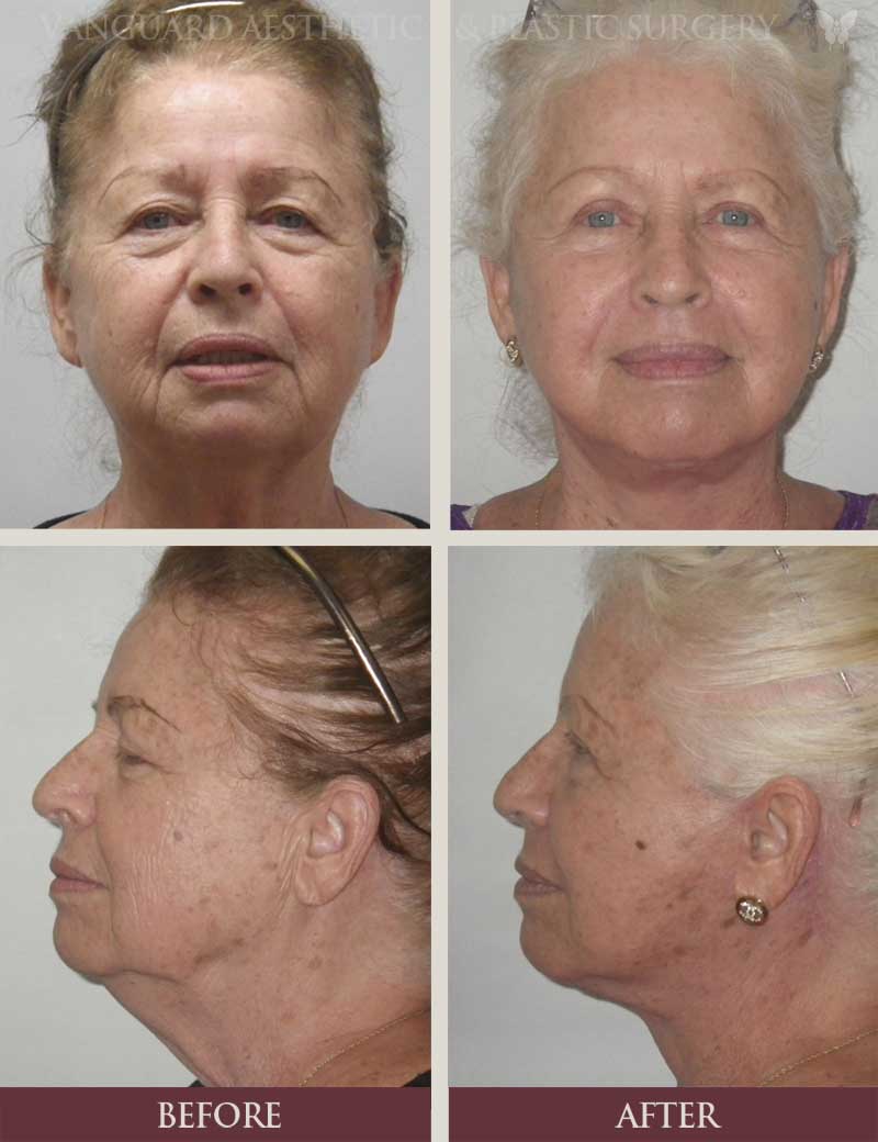 florida plastic surgery face lift before and after