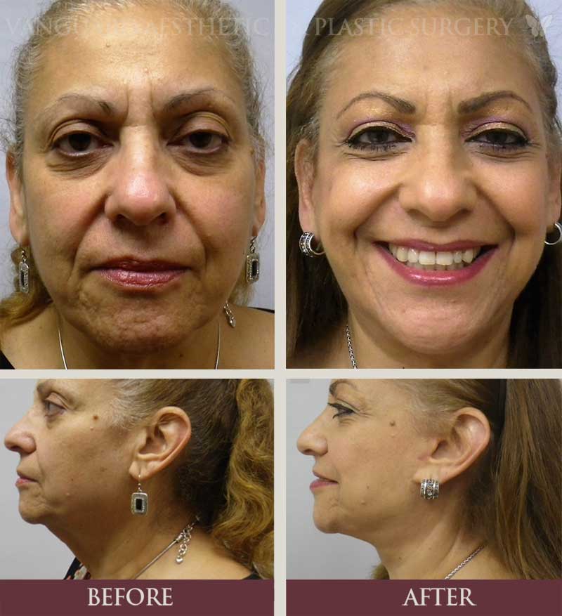 florida plastic surgery neck lift before and after