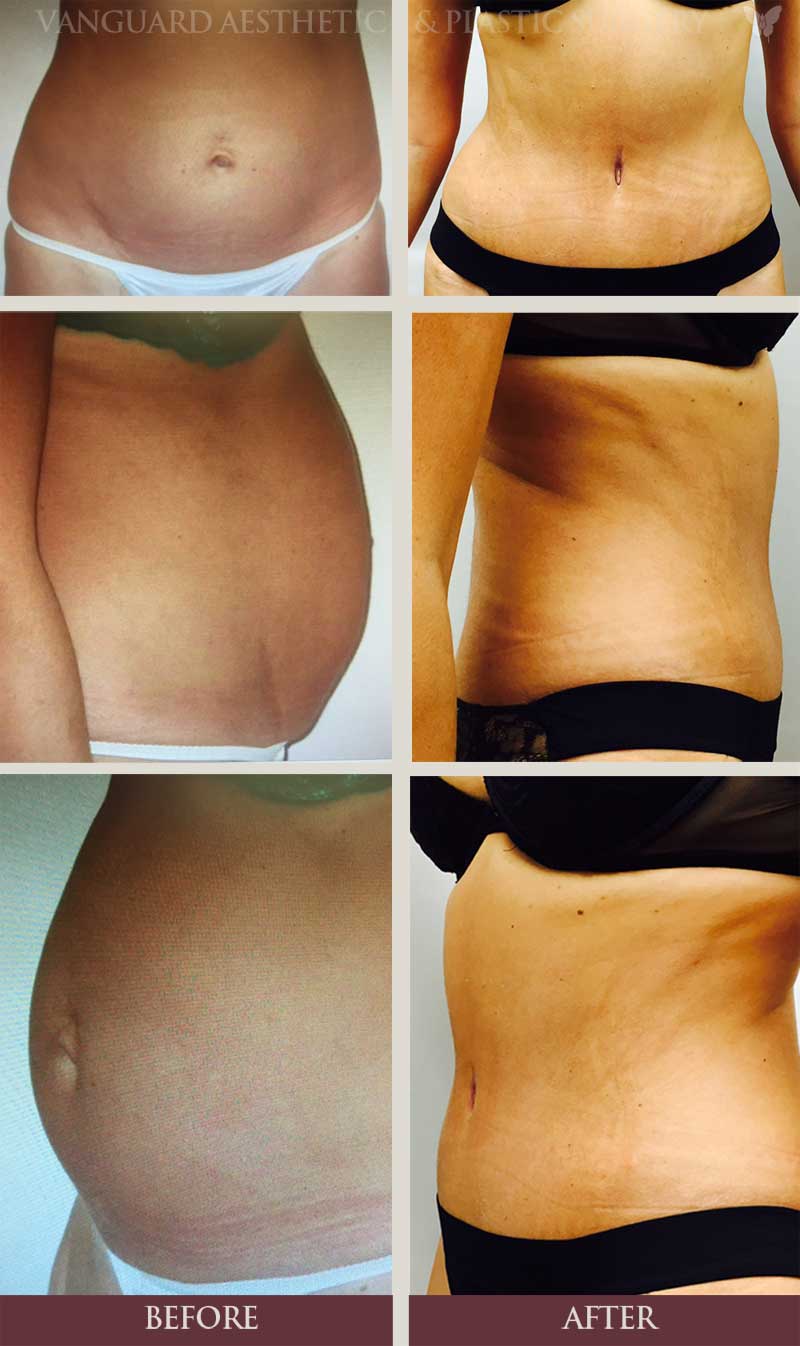 Florida plastic surgery tummy tuck before and after